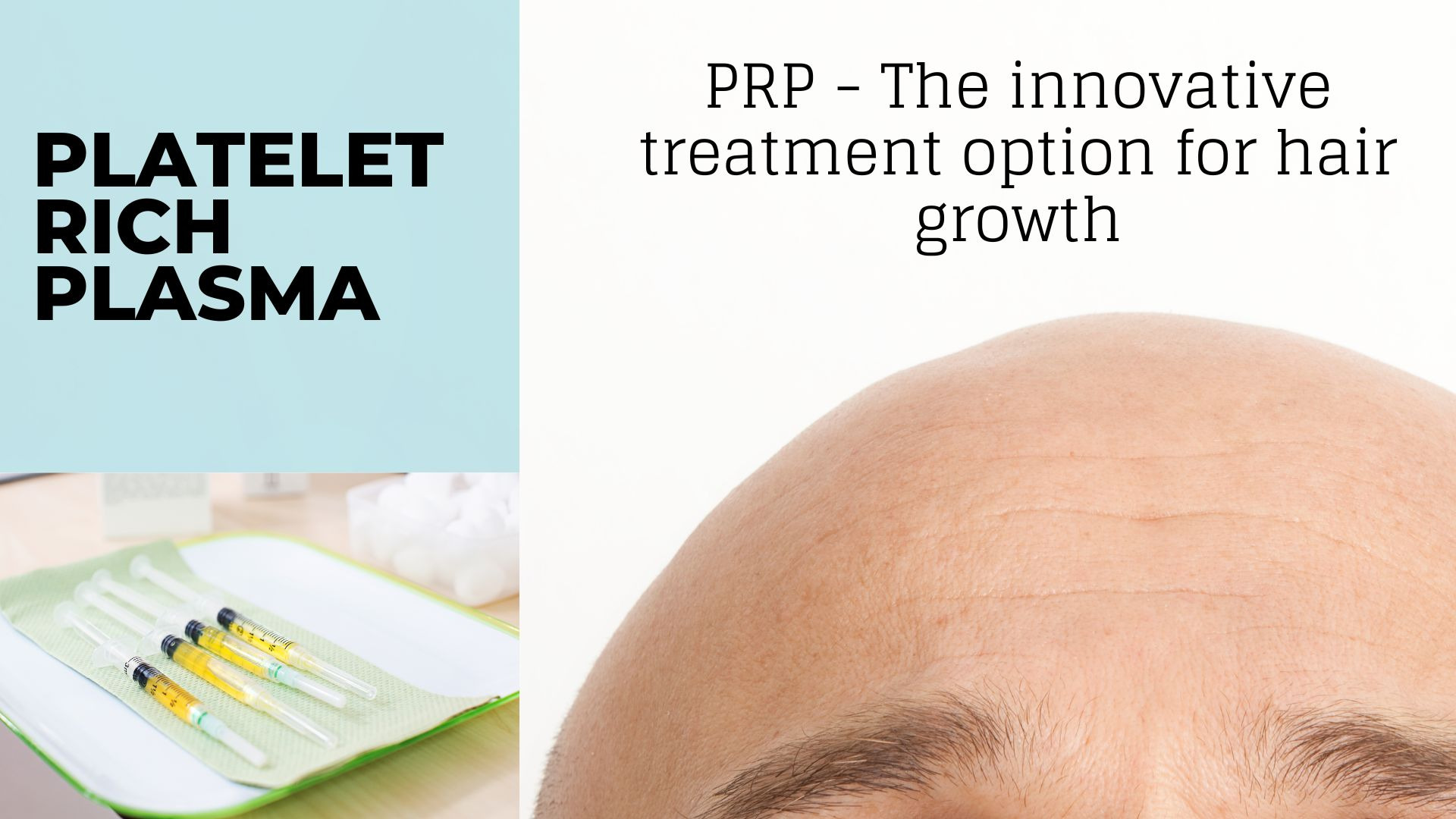PARLIAMO DI I...- PRP e crescita dei capelli: un'opzione di trattamento promettente?
